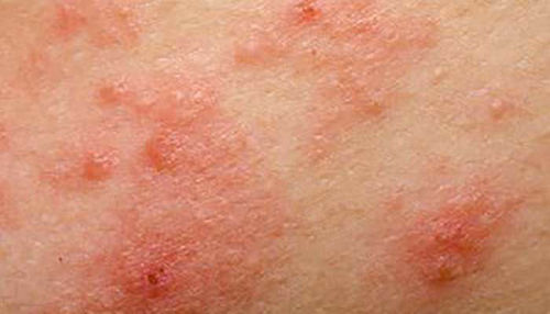 Težave z atopičnim dermatitisom pri otroku!