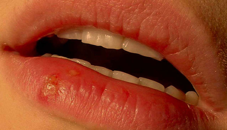 Picture ofHerpes na ustnici