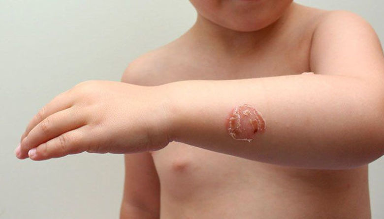 Picture ofImpetigo pri otrocih