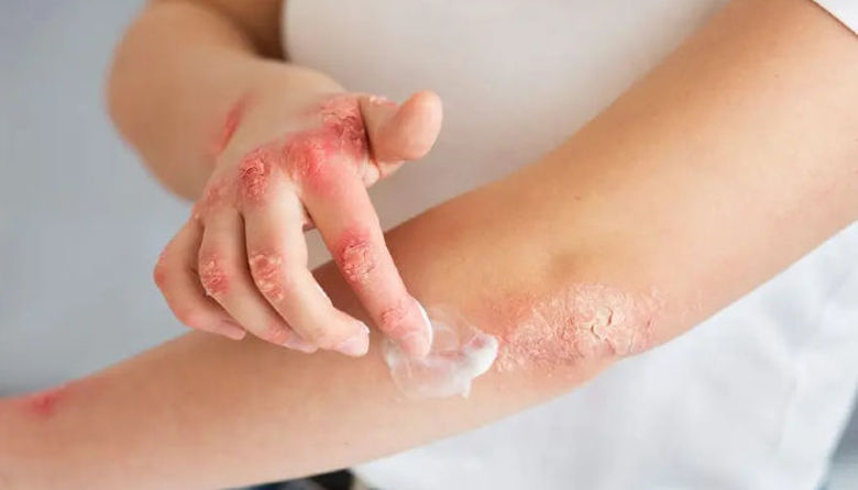 Picture ofImpetigo začetek