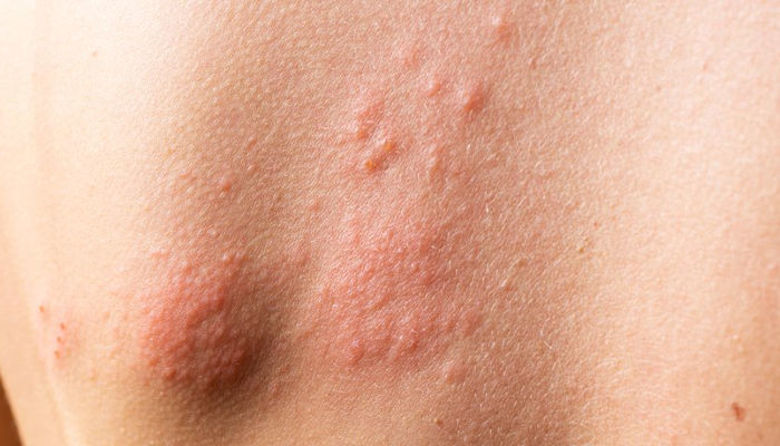 Picture ofHerpes zoster Slike