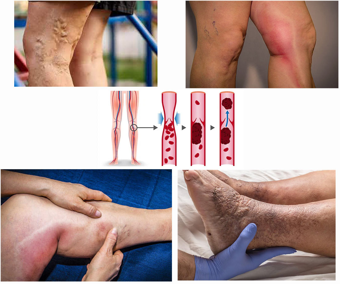 venous-thrombosis-noge