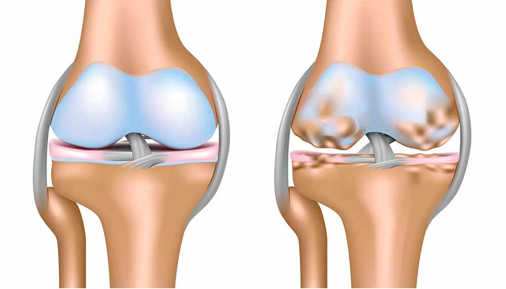 osteoarthritis-glucosamine
